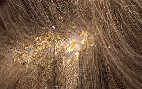 Scabs On The Scalp: Causes, Symptoms & Treatments – Vedix