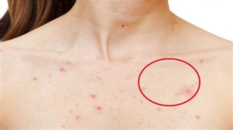 How To Get Rid Of Chest Acne Scars Youtube