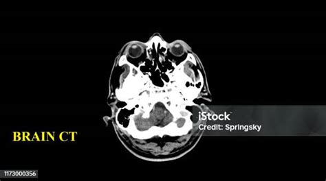 Resolusi Tinggi Ct Scan Otak Foto Stok Unduh Gambar Sekarang Istock