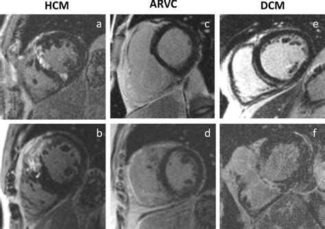 Examples Of Late Gadolinium Enhancement Lge In Six Representative