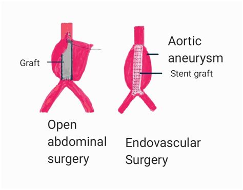 Treatment of abdominal aortic aneurysm - MANO FOR HEALTH