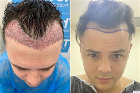 Hair Transplant Gone Wrong A Look At The Biggest Risks