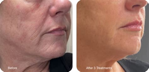 Opus Plasma Fractional Plasma Skin Resurfacing