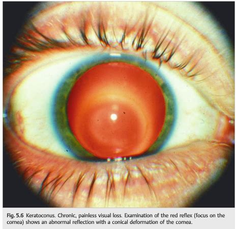 Neuro Ophthalmology Illustrated Chapter Vision Loss An Overview