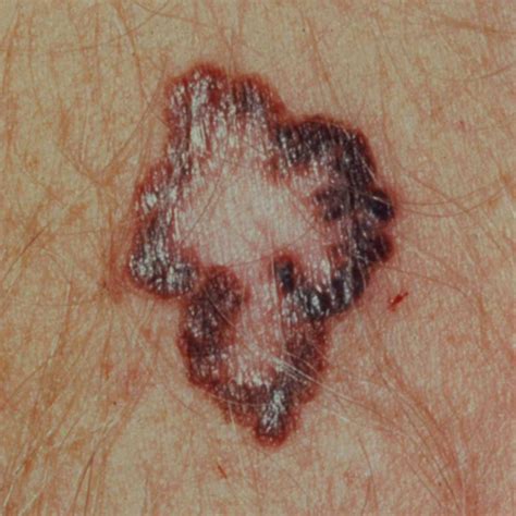 Melanoma Skin Cancer Lesions