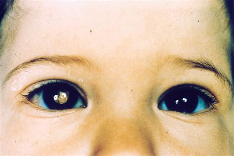 Retinoblastoma: symptoms, causes, treatment | Emergency Live