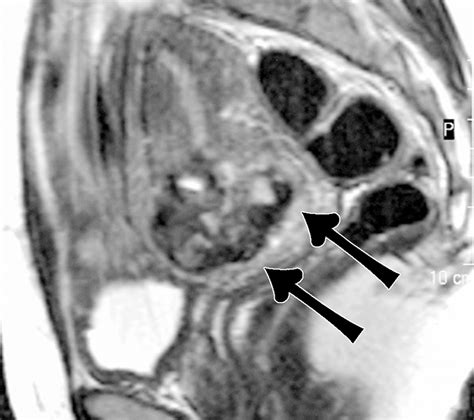 MR Imaging Of The Uterine Cervix Imaging Pathologic Correlation