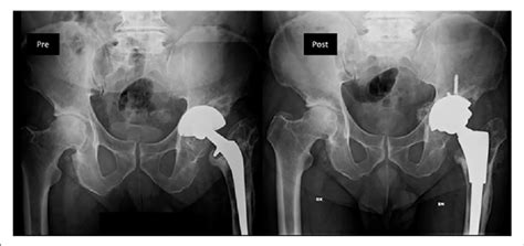 Pre Op 77 Year Old Female Aseptic Loosening Wear Debris Induced Download Scientific Diagram