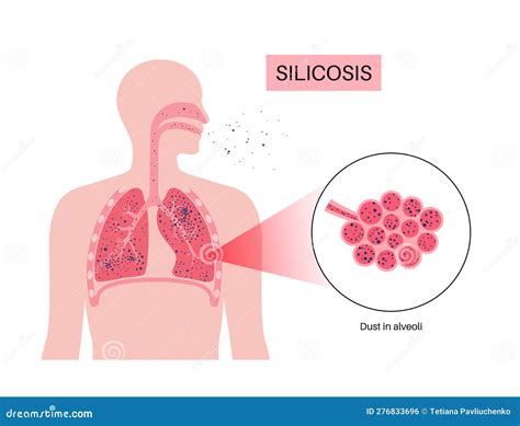 Silicosis Dust In Lung Cartoon Vector | CartoonDealer.com #278960209