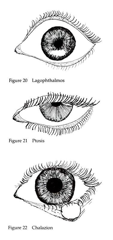 What is the Difference Between Lagophthalmos and Ptosis | Compare the ...