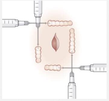 Procedures Exam Local And Regional Anesthesia Techniques Flashcards