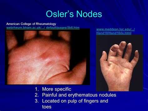 Peripheral Stigmata Of Infective Endocarditis Janeway Lesions Osler S Nodes And Splinter