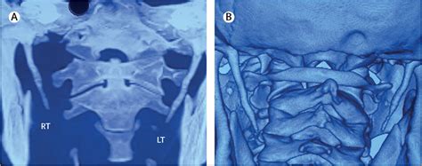 Bilateral Elongated Styloid Processes Eagle Syndrome The Lancet