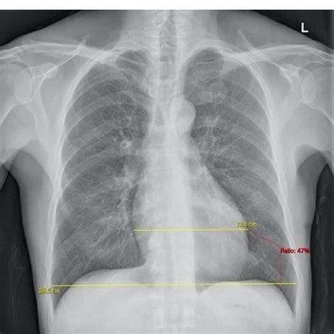 The Cardiothoracic Ratio On Pa Chest Radiograph The Maximum Transverse Download Scientific