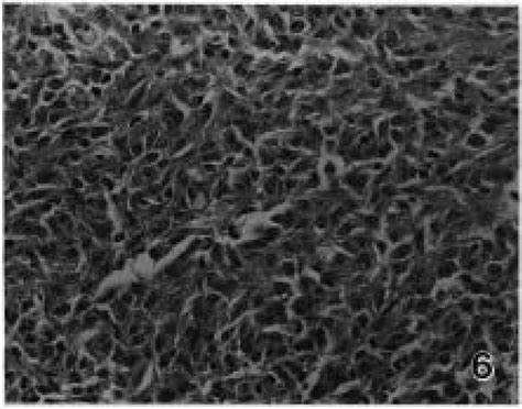 Spleen Of Spindle Cell Proliferative Disease In A Field Case Higher