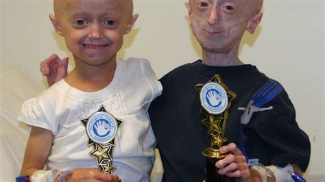 Progeria Therapy