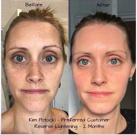 Rodan And Fields Redefine Regimen Before And After Rodan And Fields