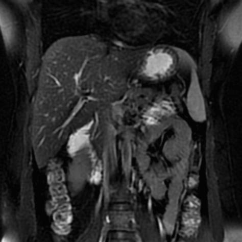 Adenoma Malignum Of Cervix Image