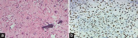 Primary Pulmonary Osteosarcoma A Rare Malignancy Of The Lung With