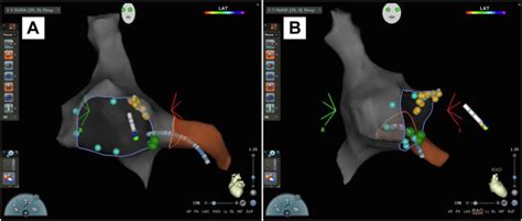 Risk Stratification For Maternal Atrioventricular Nodal Re Entrant