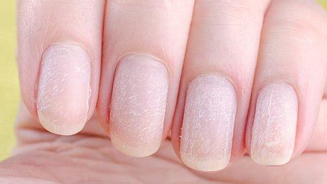 Fingernägel kauen Folgen abgewöhnen und welcher Nagellack hilft