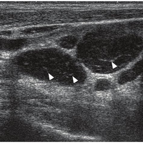 Cervical Lymph Nodes Ultrasound