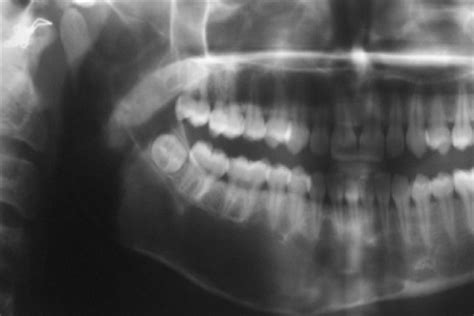 Cropped Opg Showing Well Defined Corticated Multilocular Radiolucency