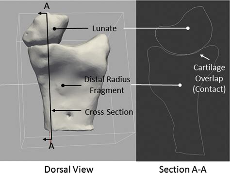 The Effect of Forearm Position on Wrist Joint Biomechanics - Journal of ...