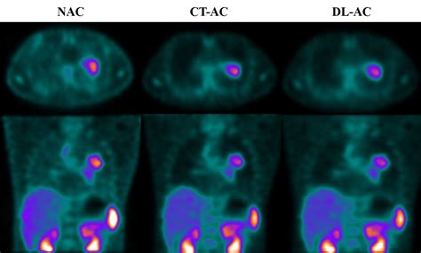 Frontiers Direct Attenuation Correction For 99mTc 3PRGD2 Chest SPECT