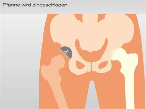 Oberflächenersatz Am Hüftgelenk Nach Mcminn − Die Operation Gelenkzentrum