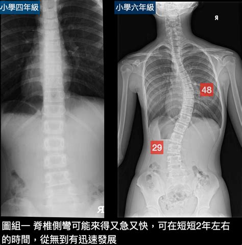 脊椎側彎怎麼看？簡單3徵兆＋5症狀判斷，徹底了解不再擔心害怕！