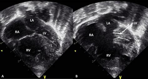 Hypoplastic Left Heart Syndrome Thoracic Key