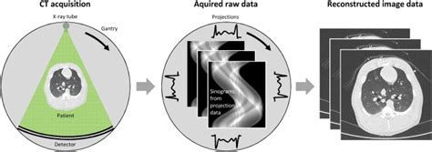 Basics Of Iterative Reconstruction Methods In Computed Tomography A Vendor Independent Overview