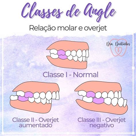 Dra Dentinhos on Instagram Classes de Angle São definidas