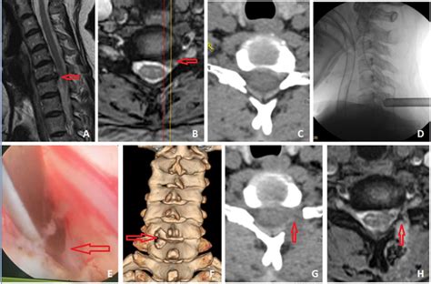 A Patient With Csr C6 7 Left Foraminal Bony Stenosis Female 52