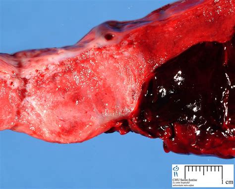 Retroplacental Hematoma Humpath Human Pathology Photos