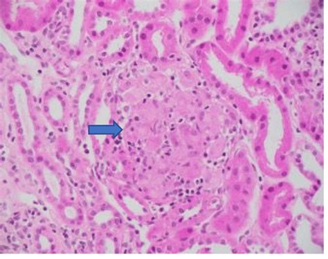 Non‐necrotizing Granulomatous Tubulointerstitial Nephritis With Small