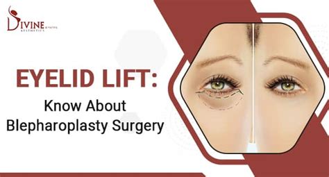 Eyelid Lift Blepharoplasty Surgery Benefits Procedure Steps