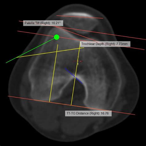 Orthopedic Software Sport Medicad Hectec Gmbh Diagnostic Planning Knee