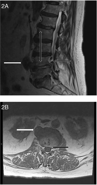 A And B Magnetic Resonance Imaging Showing Psoas Abscess White