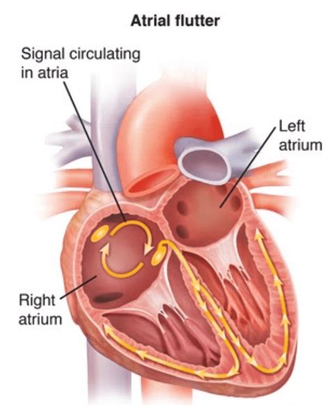 Atrial Flutter Symptoms Ladegdc