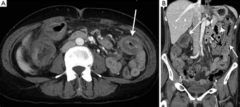 Learn Ct Scan Anatomy Ct Axial Abdomen And Pelvis Male Images