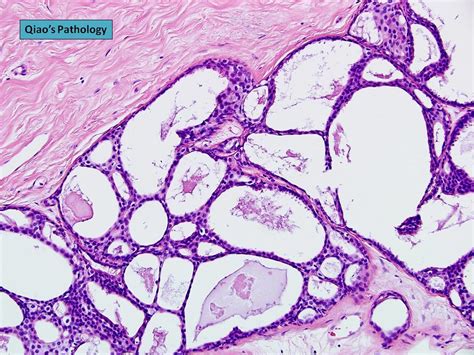 Qiao S Pathology Atypical Ductal Hyperplasia Adh Flickr