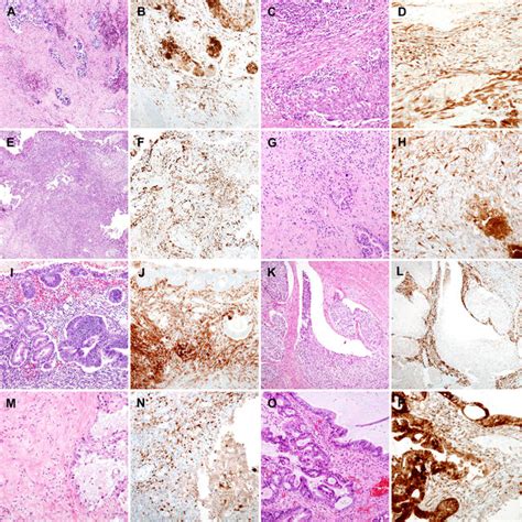 Stromal P16 Overexpression In Benign Ovarian Tumors A Serous