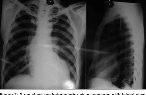 Figure 2 From Radio Opaque Tricuspid Aortic Valve Seen In X Ray Chest