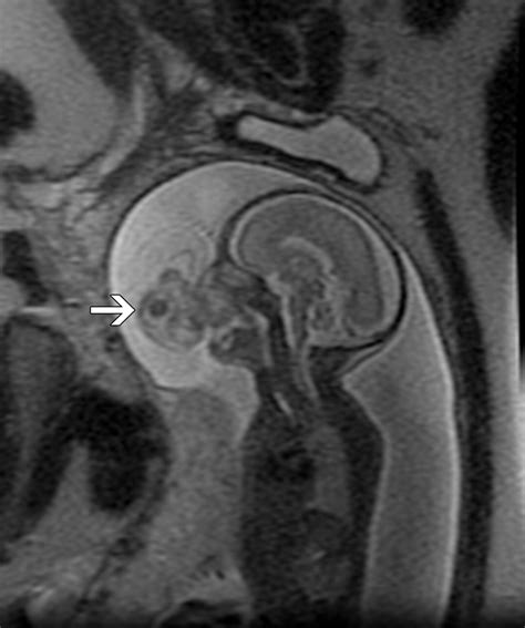 Congenital Oral Masses An Anatomic Approach To Diagnosis Radiographics