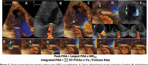 Figure 1 From Quantification Of Chronic Functional Mitral Regurgitation