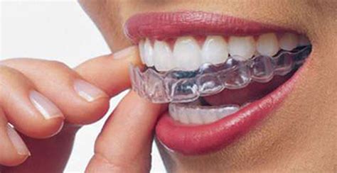 Invisalign Teeth Straightening Bryan Levy And Associates