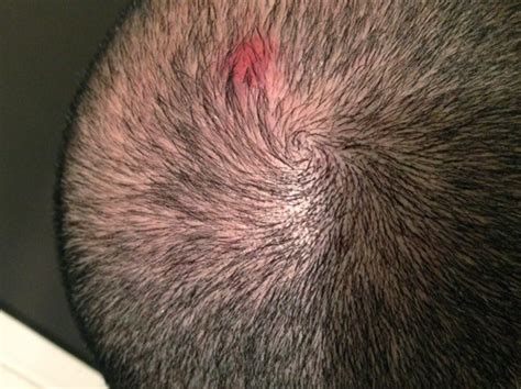 Itchy Bumps On Head