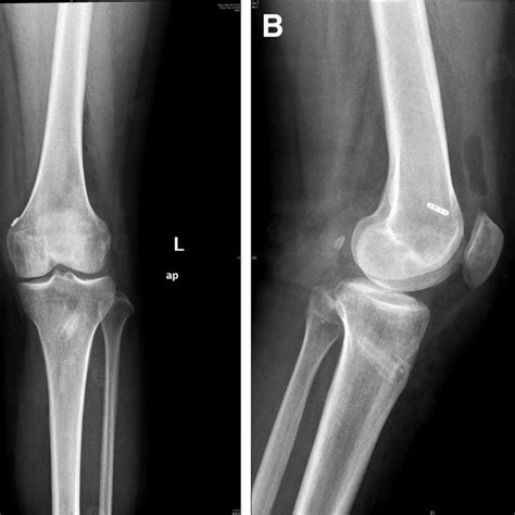 A Side View Of The Posterior Cruciate Ligament Pcl Tibial Guide